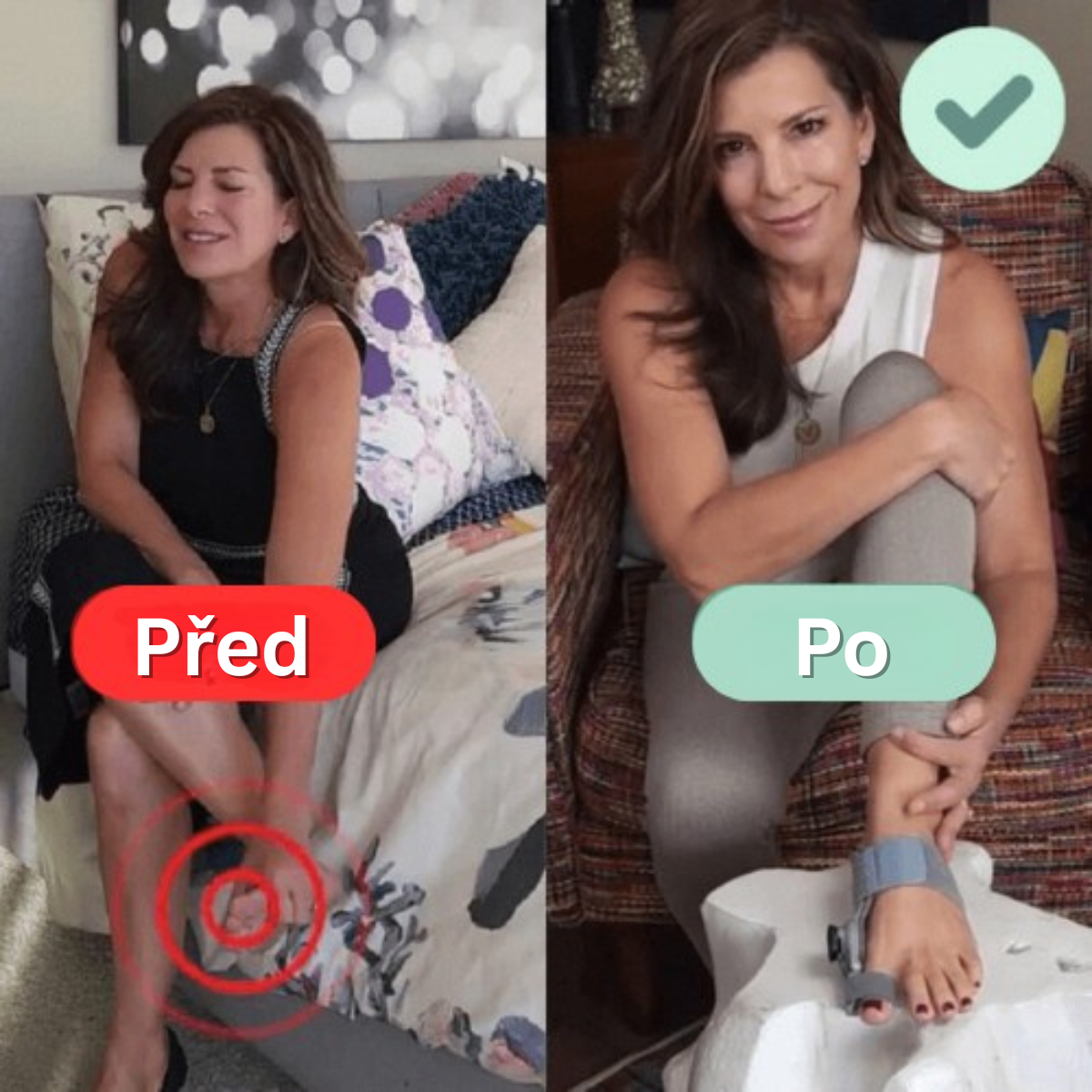 Léčebný balíček pro vbočený palec (Hallux Valgus)