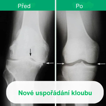 OrthoKnee™ – Dlouhodobá úleva od artritidy a bolesti kloubů